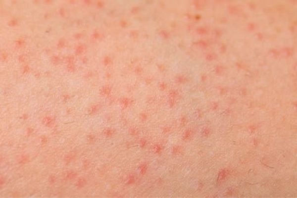 4 Common Skin Disease During Summer And Remedies