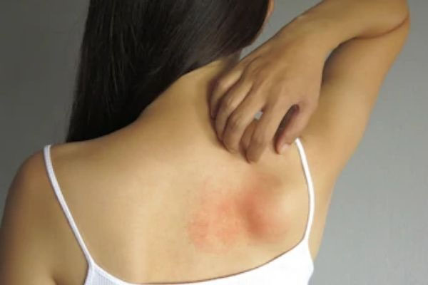 4 Common Skin Disease During Summer And Remedies